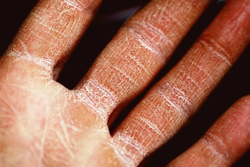 dry skin recovery guide